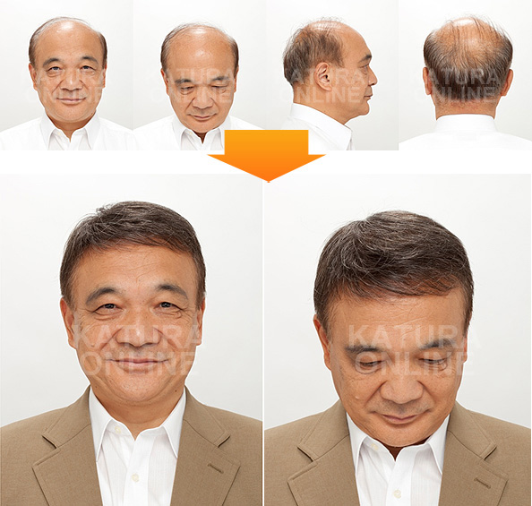かつらの使用前、使用後(70代) mounting_img_05