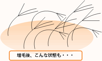 増毛2~3か月後 増毛2~3か月後