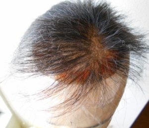 かつらの脱毛 かつらの脱毛