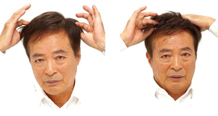 かつらのピン装着 かつらのピン装着