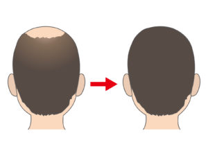 頭頂部に植毛? 頭頂部に植毛?