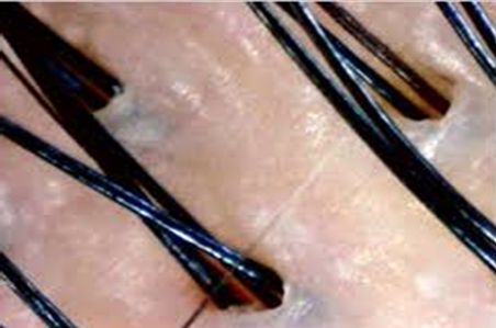 頭皮の毛穴の様子 頭皮の毛穴の様子